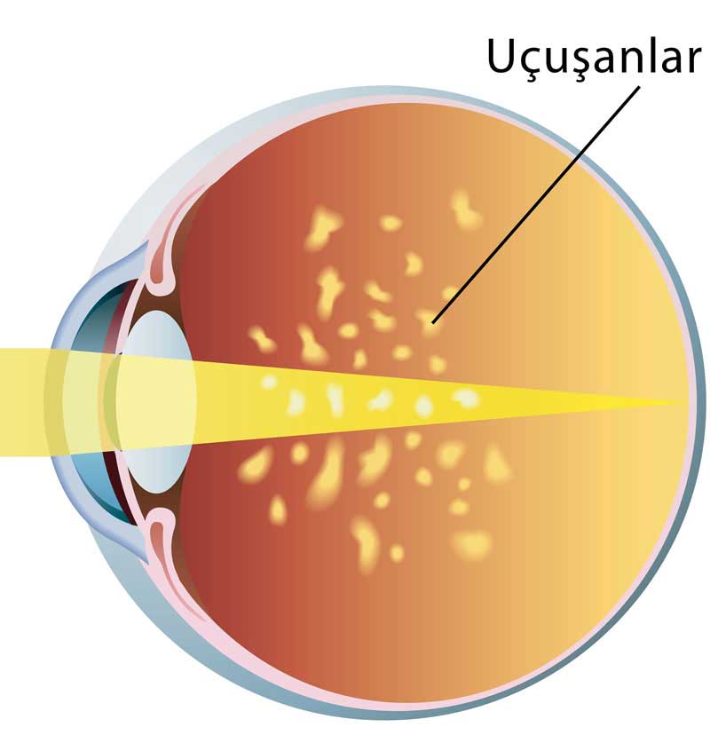 Vitreus Dejenerasyonu-Gözde Uçuşmalar-Vitreus Opasitesi
