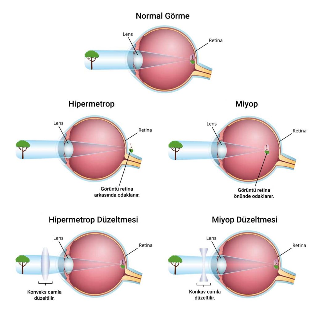 Miyop-Hipermetrop