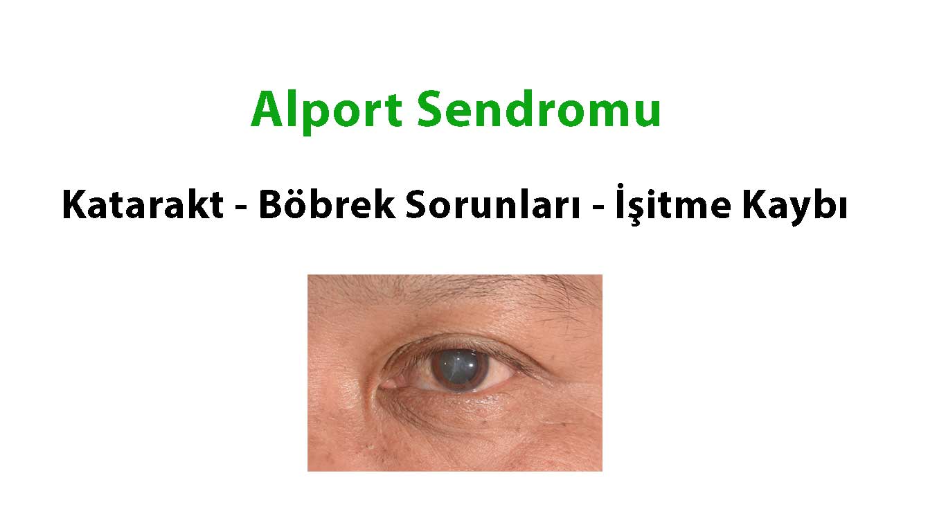 Alport Sendromu-Anterior Lentikonus ve Katarakt