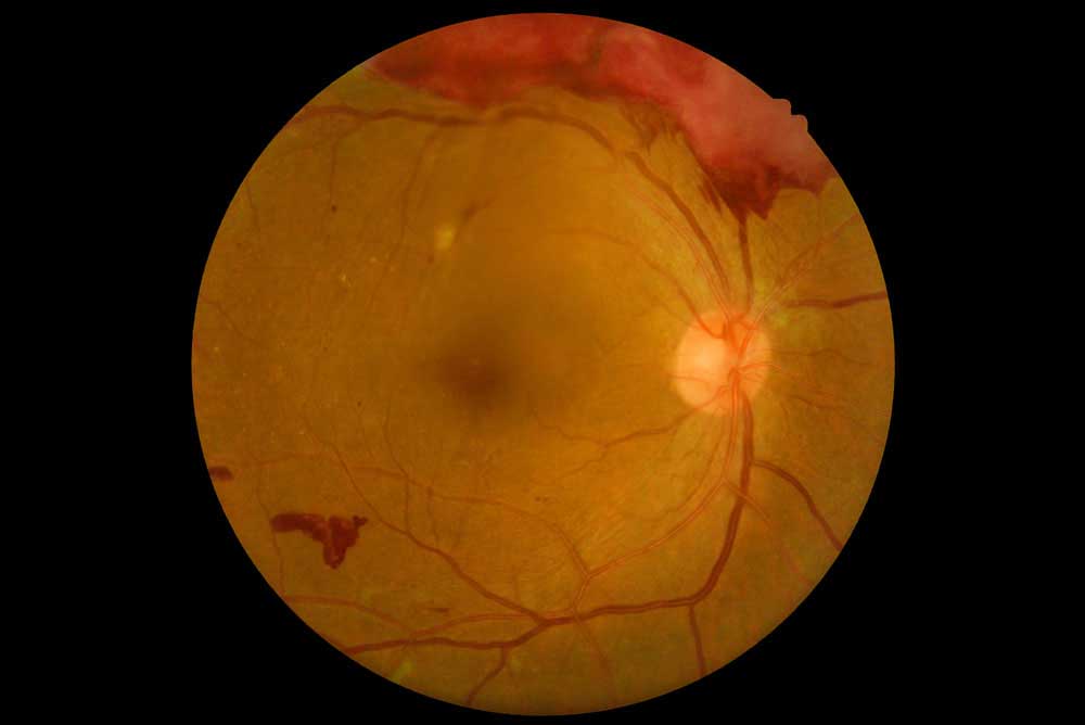 Diyabetik Retinopati-Şeker Hastalığına Bağlı Göz Sorunları