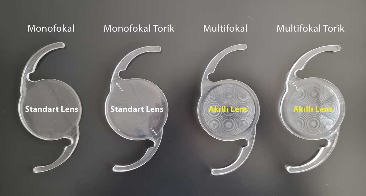 Göz İçi Mercekler-Kalıcı Lens